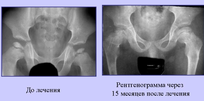 Симптомы миелодисплазии